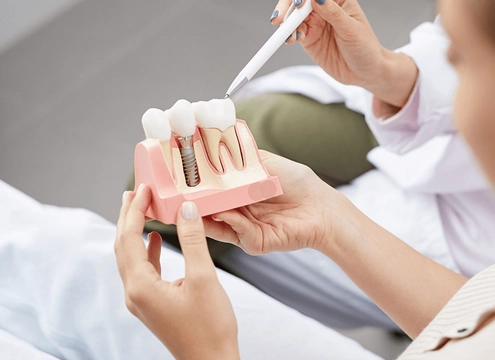 İmplant Tedavisi Ne Kadar Sürer?